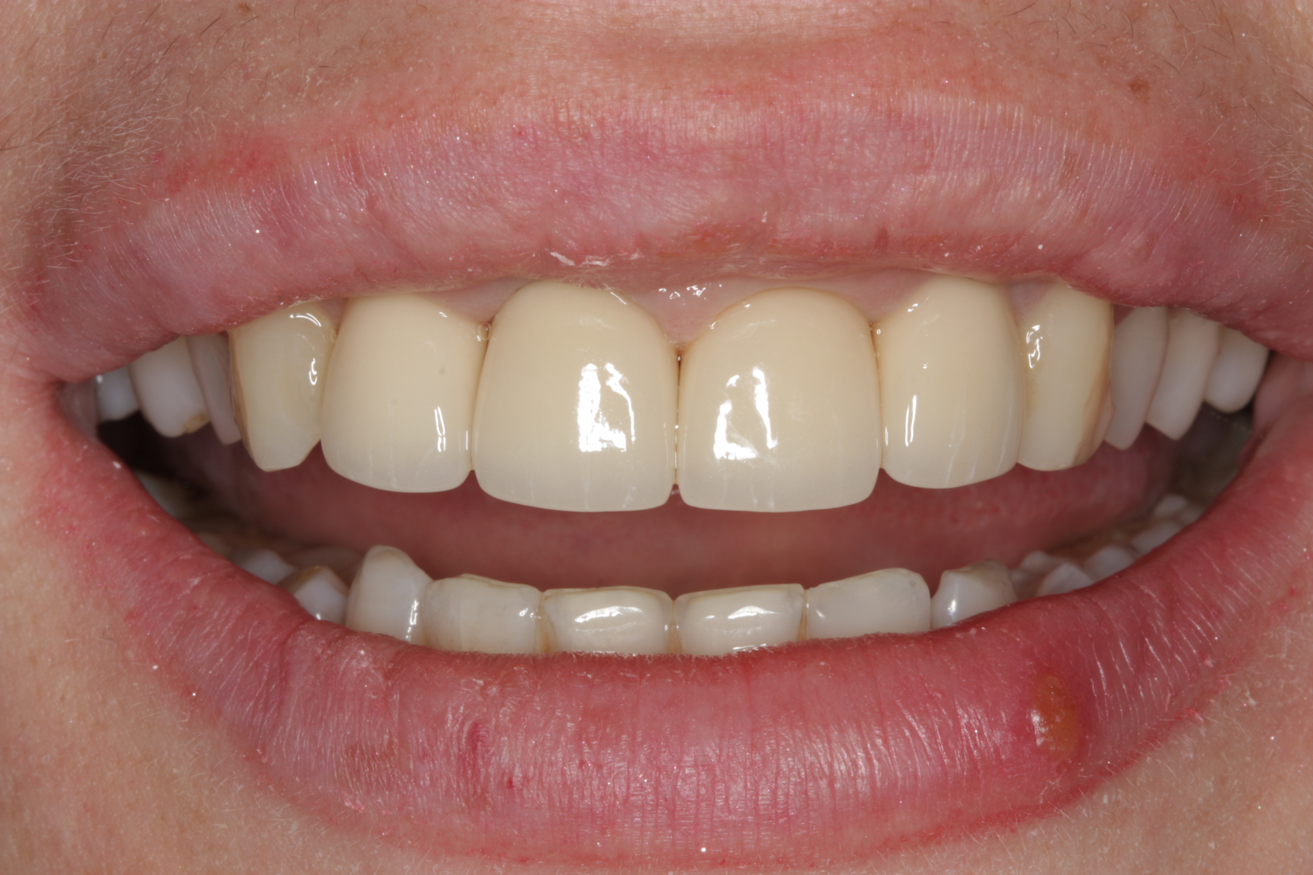 зубы отпрепарированы под металлокерамический протез