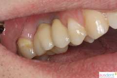 Окончательный вид протезировая зубов металлокерамическими коронками
