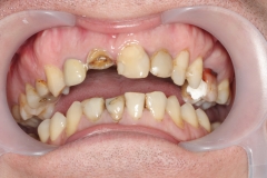 сломан передний зуб и неудовлетворительная эстетика остальных зубов