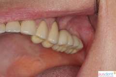 Окончательный результат имплантации зубов
