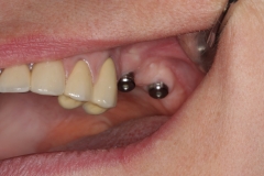 в области отсутствующего шестого,седьмого зубов, на верхней челюсти, установлены два имплантата, и на них установлены формирователи десны