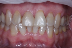 Вид четерых передних зубов после реставрации в другой клинике. Пациент недоволен результатом