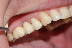 металлокерамический протез в полости рта (окончательный вид протезирования)