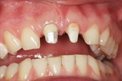 Восстановление зубов культевыми вкладками на основе диоксида циркония и золота